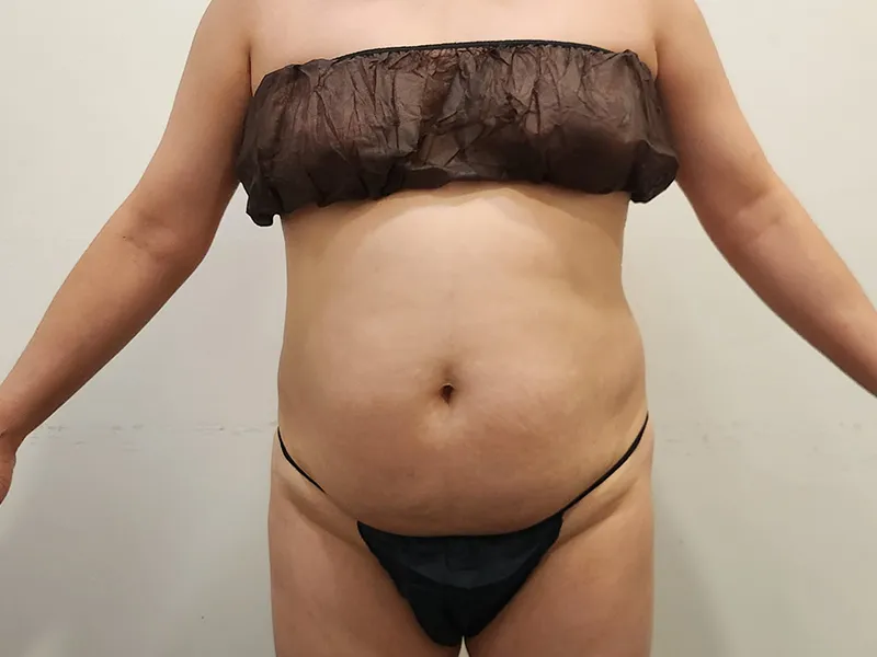 腹部脂肪吸引 術前
