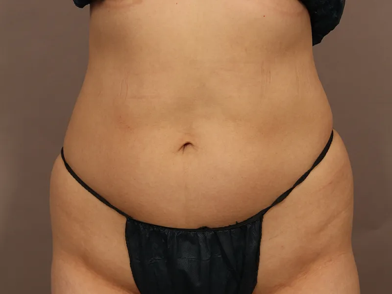 腹部脂肪吸引 術前