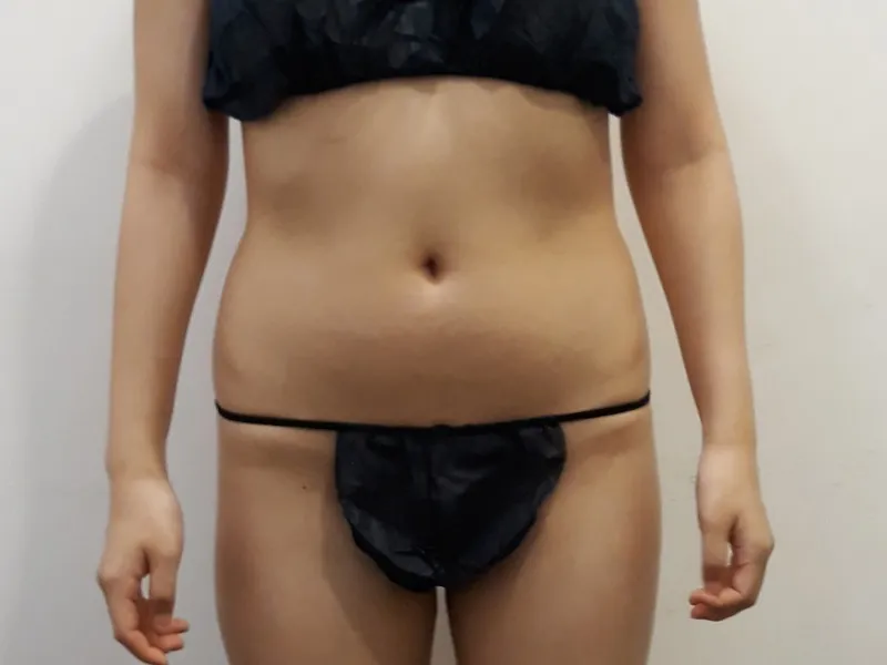 腹部脂肪吸引 術前