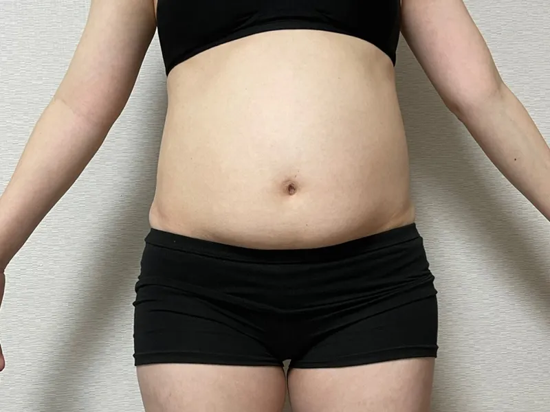 腹部脂肪吸引 術前