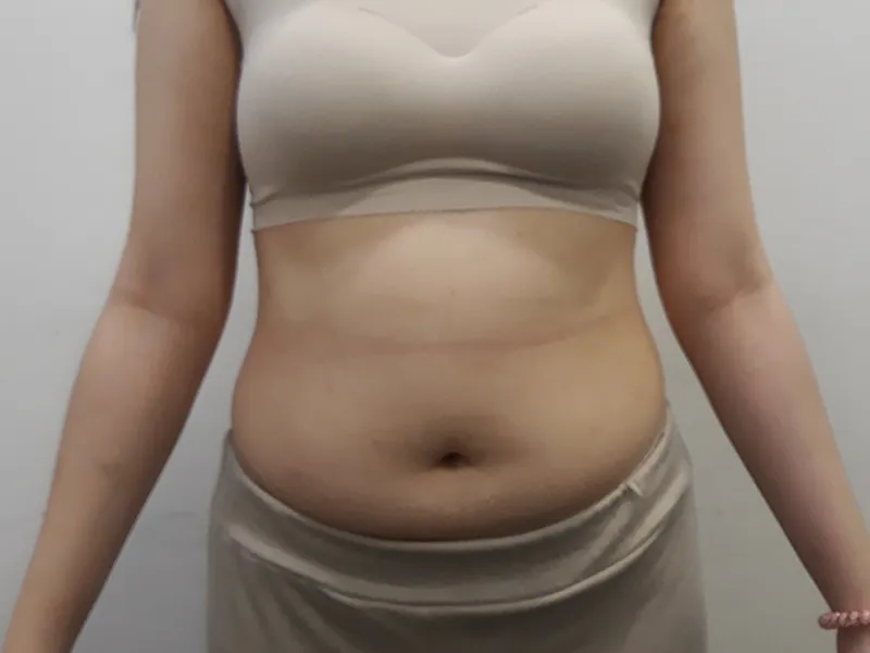 腹部脂肪吸引 術前