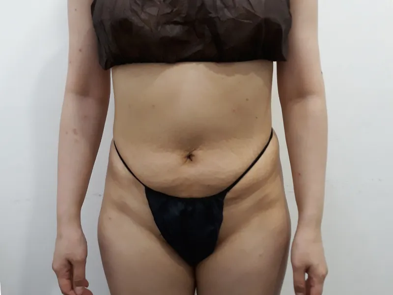 腹部脂肪吸引 術前