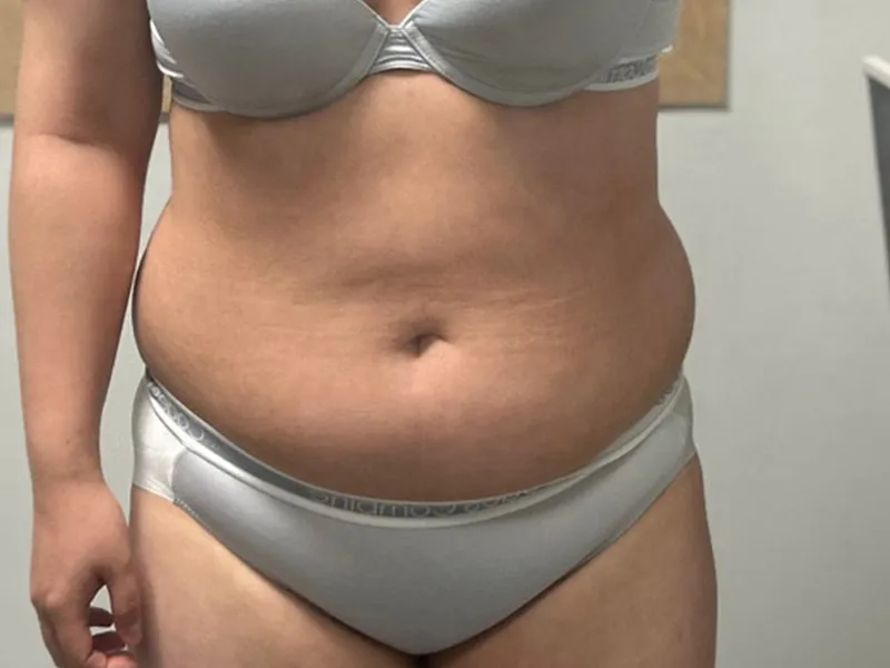 腹部脂肪吸引 術前