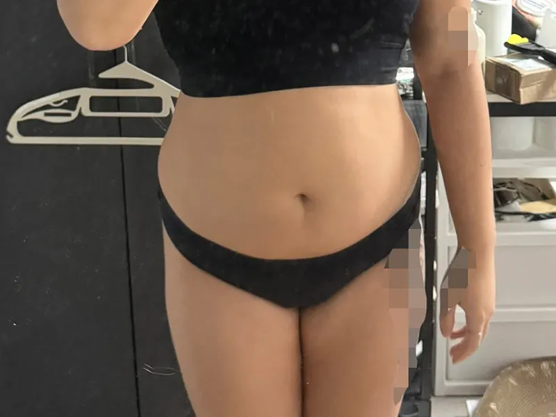 腹部脂肪吸引 術前