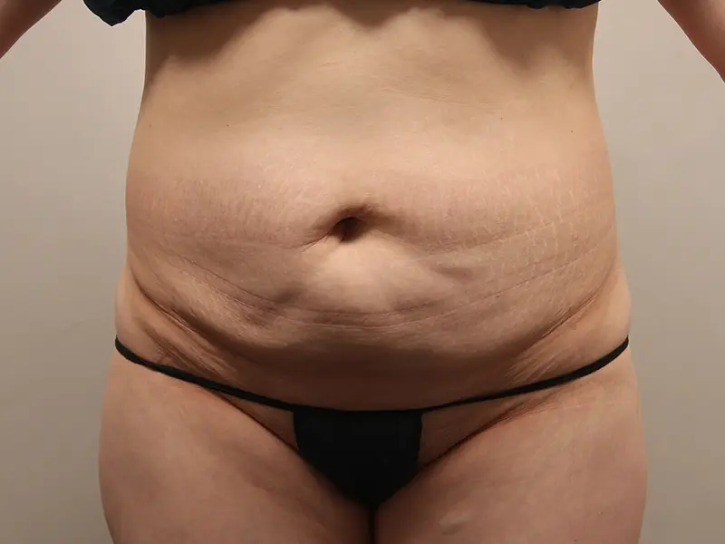 腹部形成術 術前