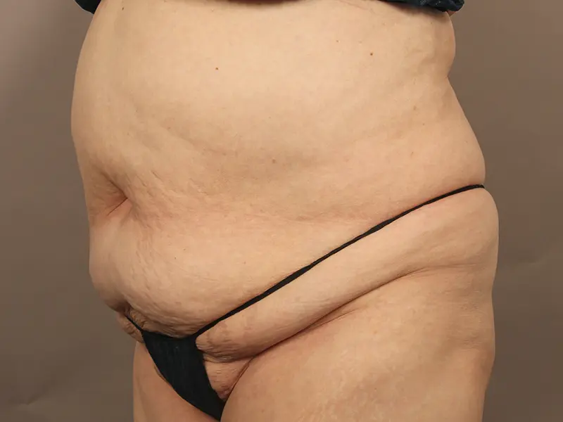 腹部形成術 術前