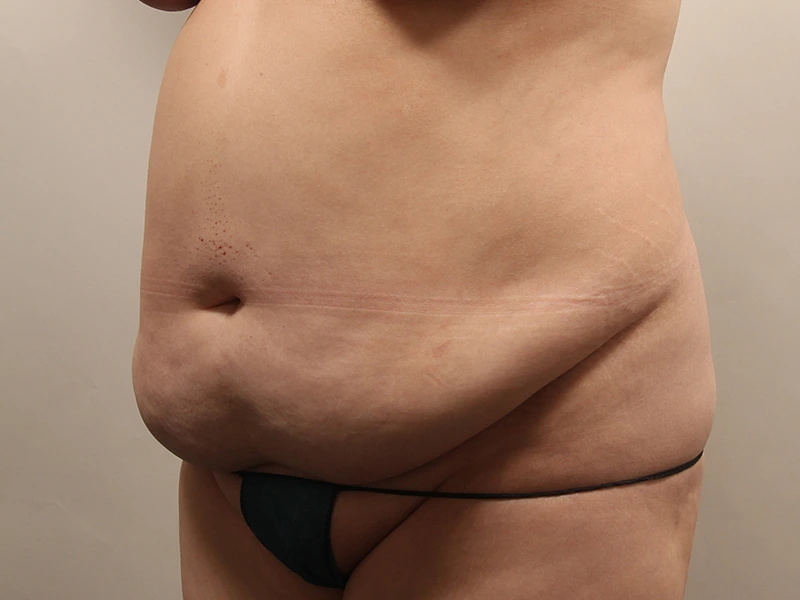 腹部形成術 術前