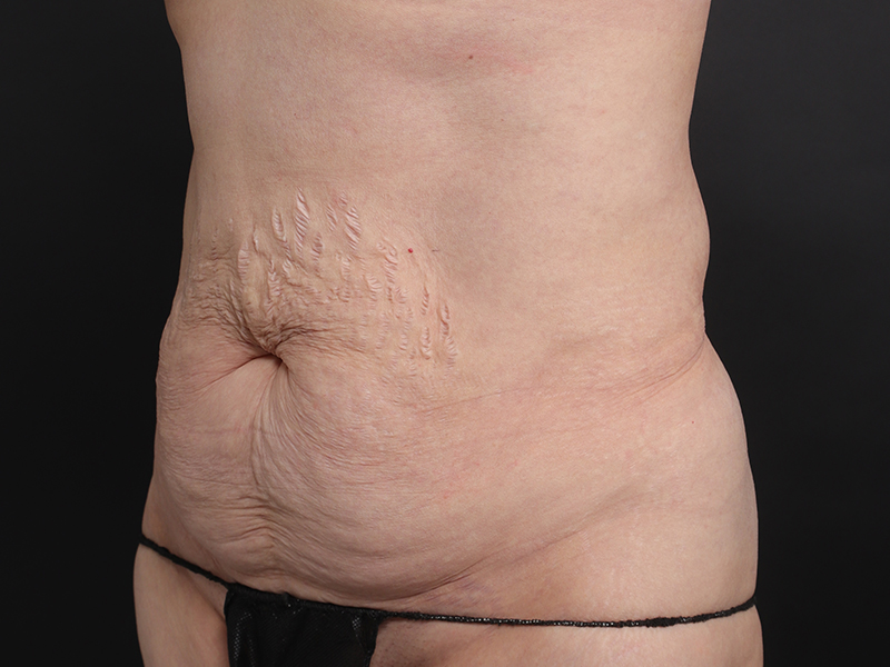 腹部形成術 術前