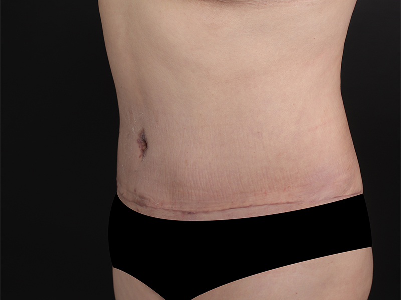 腹部形成術 術前