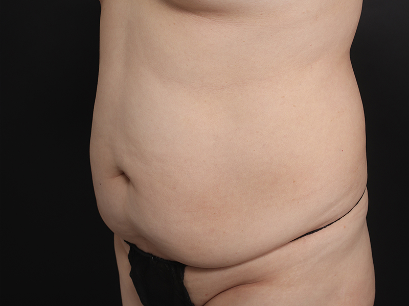 腹部形成術 術前