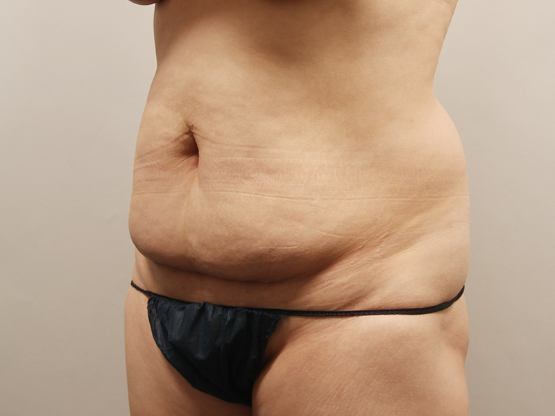 腹部形成術 術前