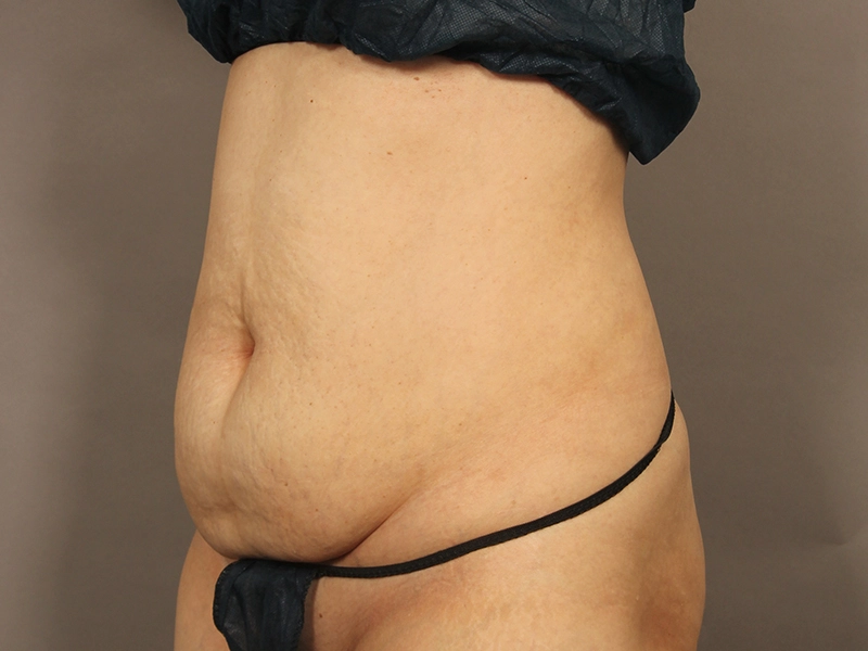 腹部形成術 術前