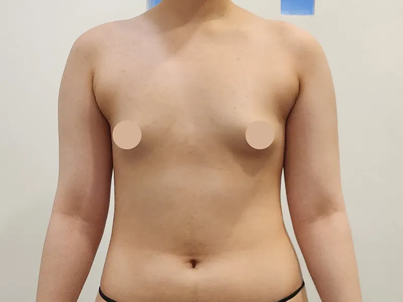 バスト脂肪注入 術前