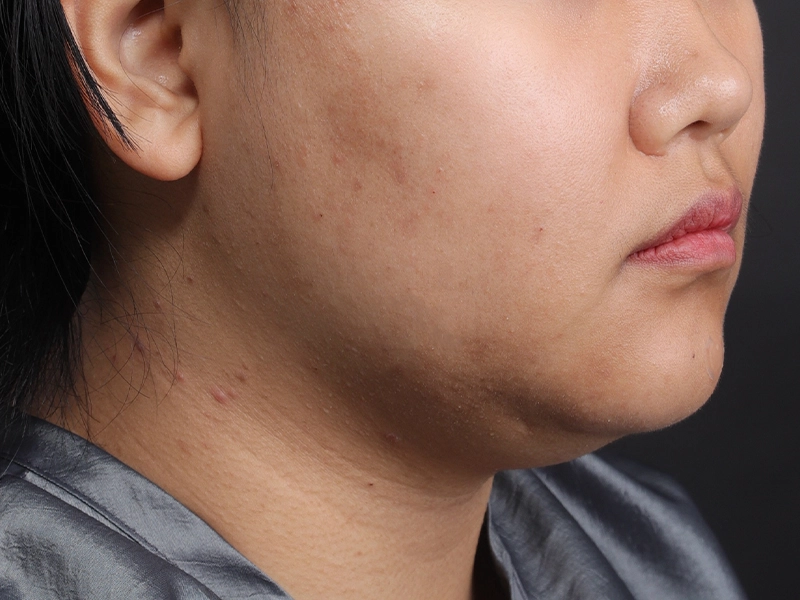 顔部脂肪吸引 術前