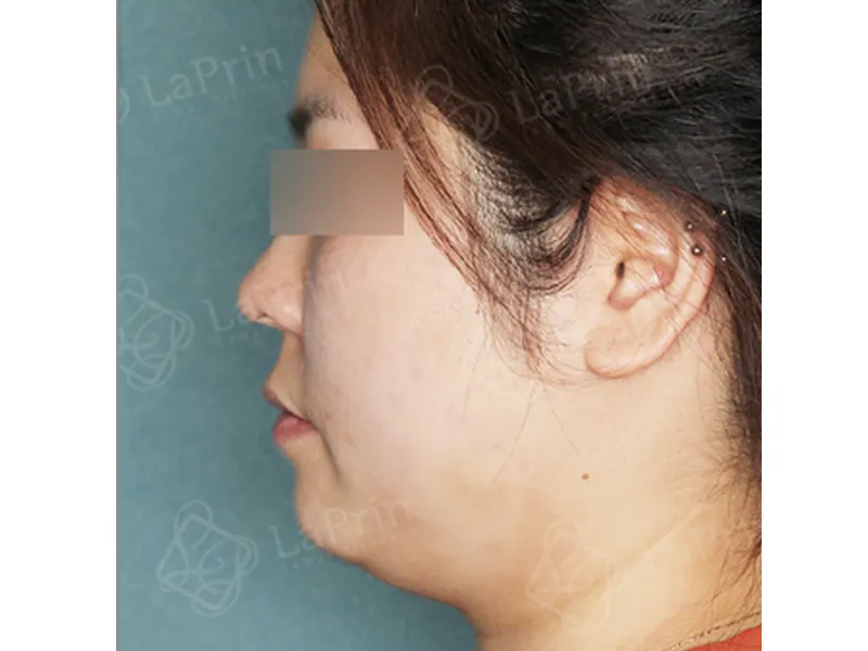 顔部脂肪吸引 術前