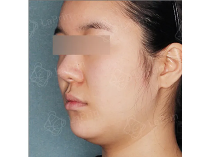 顔部脂肪吸引 術前
