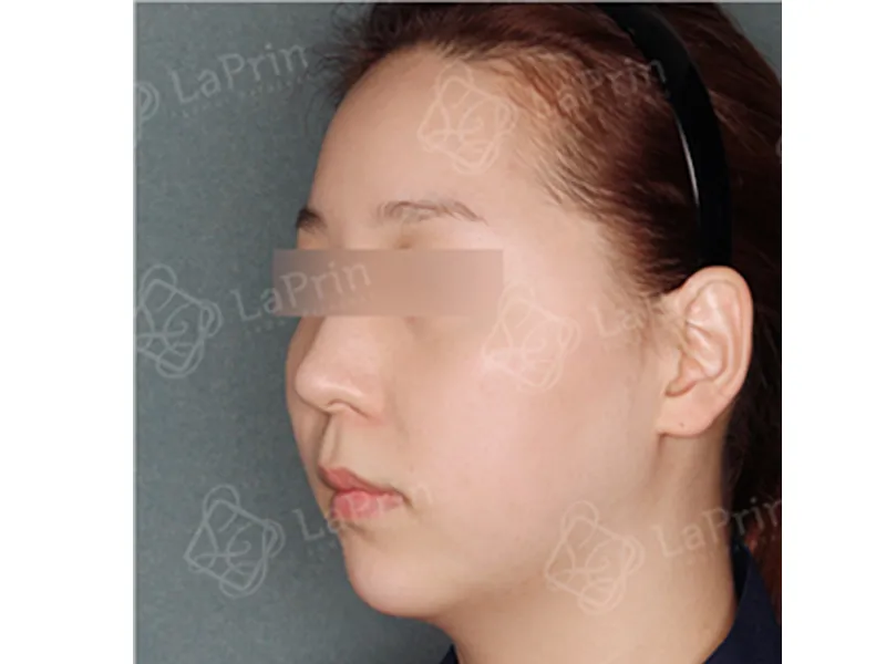 顔部脂肪吸引 術前