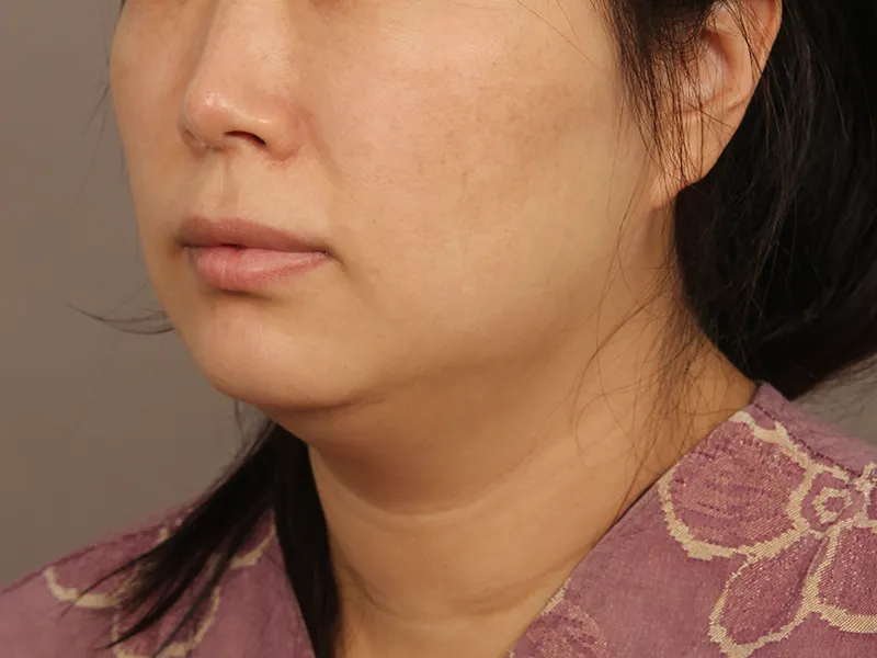 顔部脂肪吸引 術前