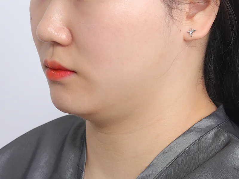 Before Facial Liposuction