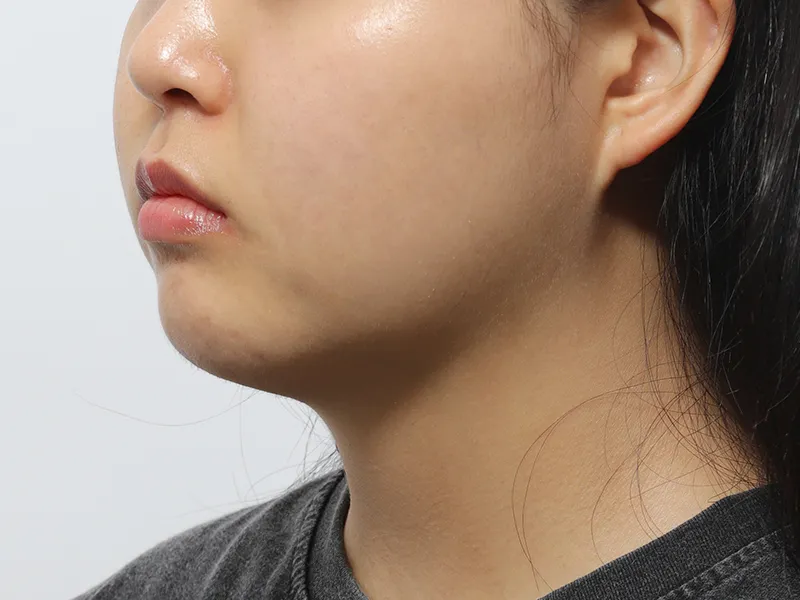 Before Facial Liposuction