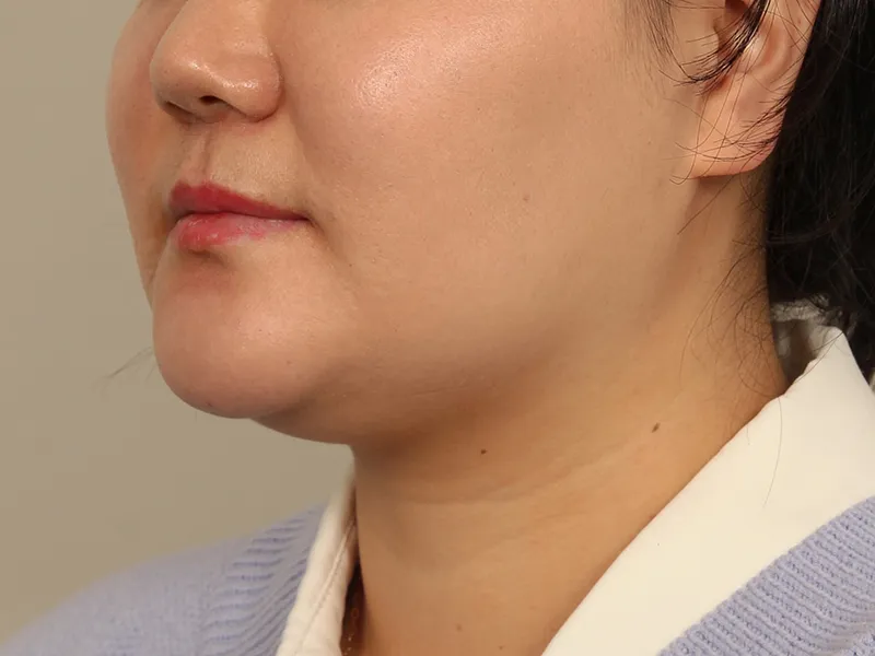 顔部脂肪吸引 術前