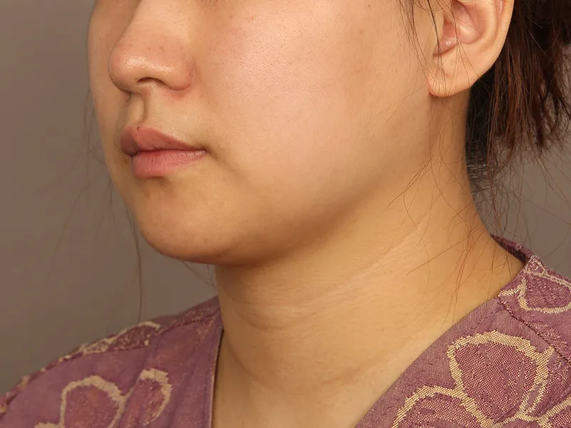 顔部脂肪吸引 術前