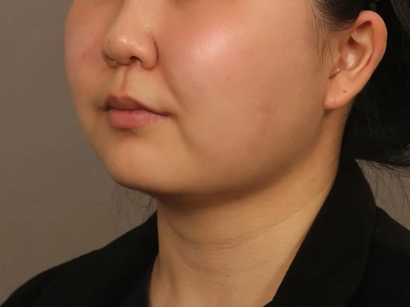 顔部脂肪吸引 術前