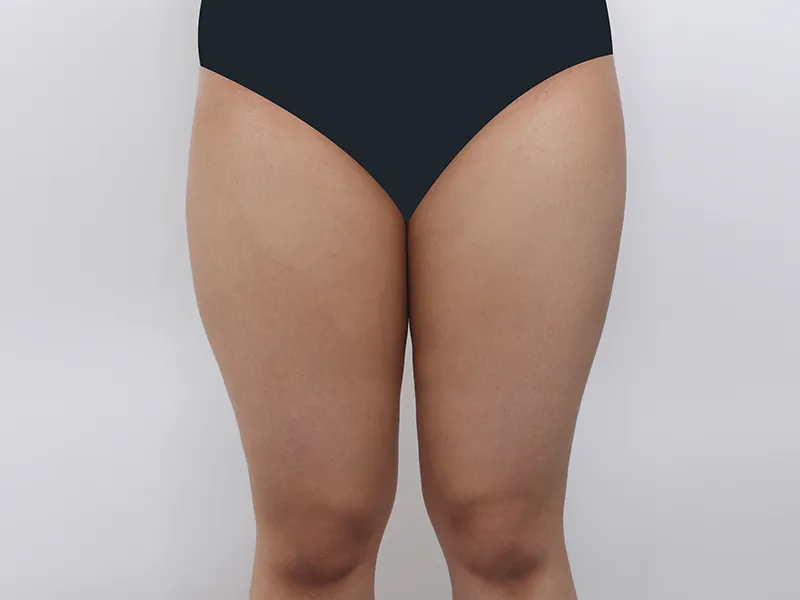 太もも脂肪吸引 術前