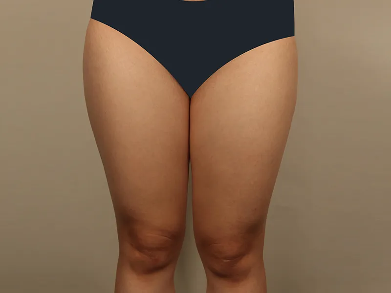 太もも脂肪吸引 術前