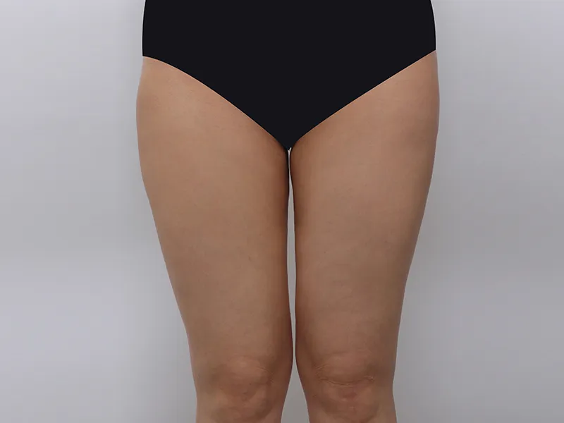 太もも脂肪吸引 術前