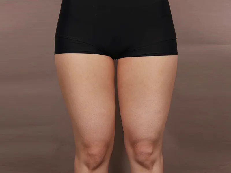 太もも脂肪吸引 術前