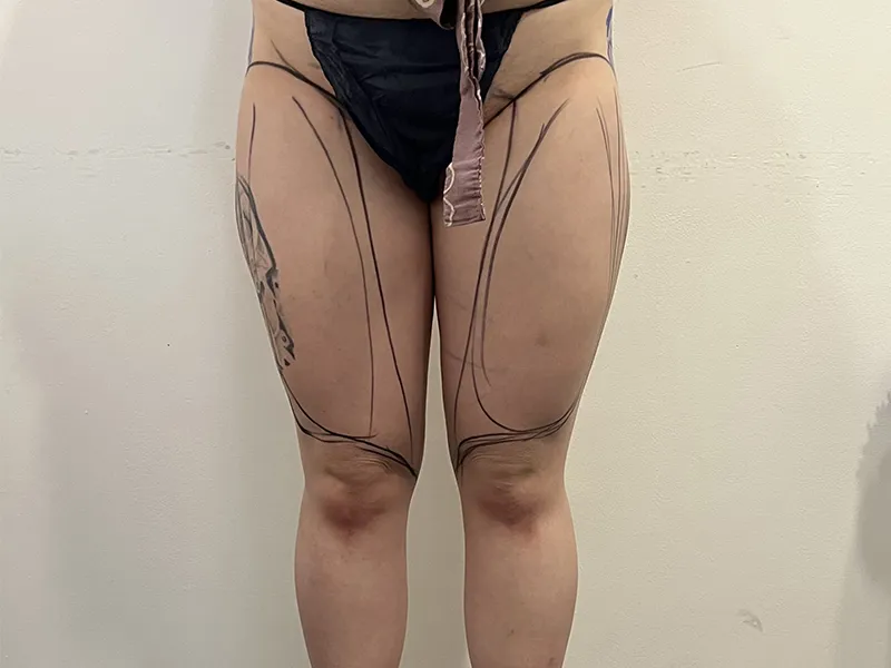 太もも脂肪吸引 術前