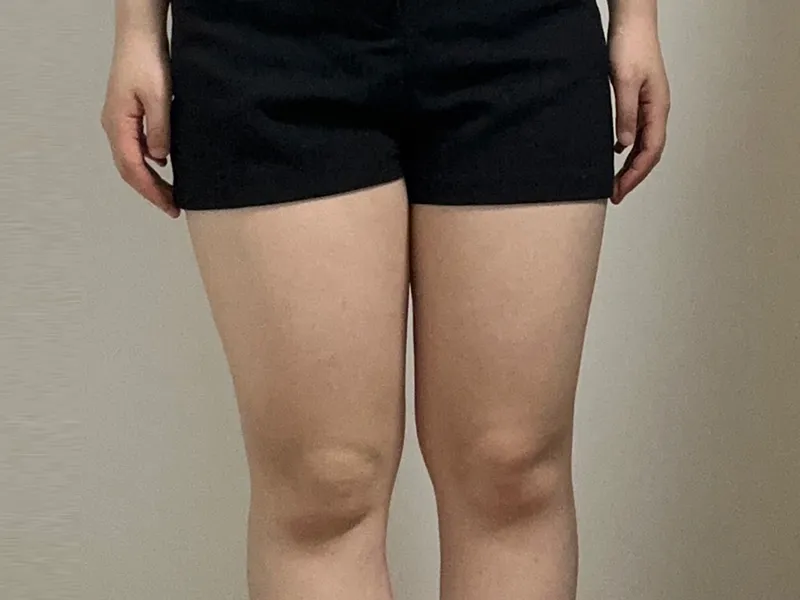 太もも脂肪吸引 術前