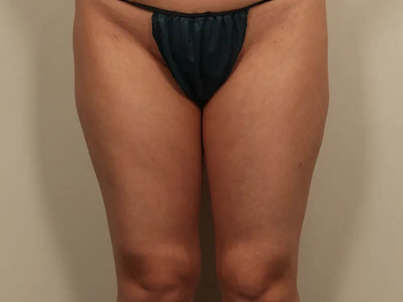 太もも脂肪吸引 術前