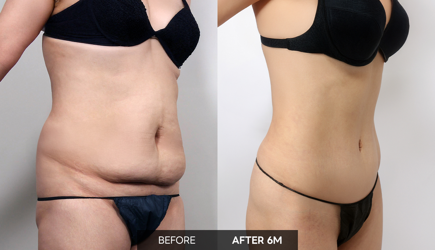 30대 복부성형 전후 — 출산 후 처짐과 복직근 분리 복구