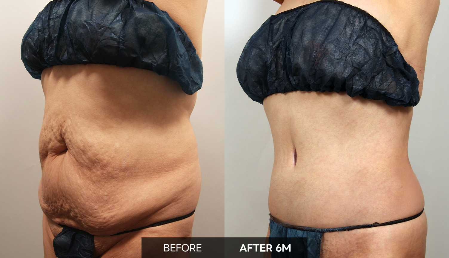 30대 중반 E-Lipo + 전체 복부성형 전후