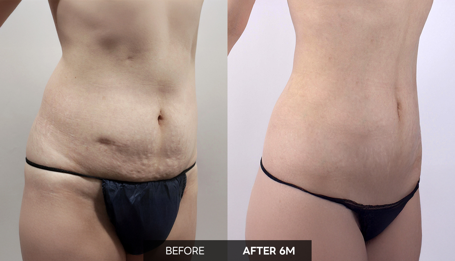 40대 초반, Renuvion 미니 긴축 전후